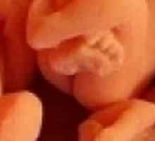 Avortul într-un stadiu incipient - cauzele și consecințele