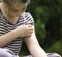 Alergic la mușcăturile de țânțari și alte insecte la copii
