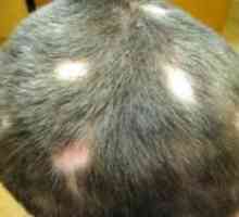 Alopecia la copii