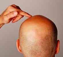 Alopecia la nou-născuți: tipuri și cauze