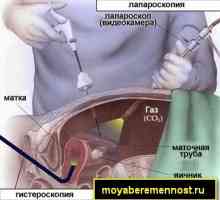 Sarcina dupa laparoscopie