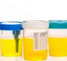 Analiza biochimică a urinei