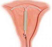 Ce trebuie să știți despre menstruație după spirala?