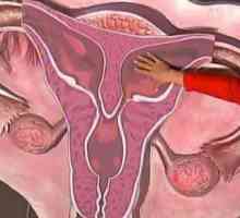 Ce este uterul cu două coarne? Sarcina și anomalie.