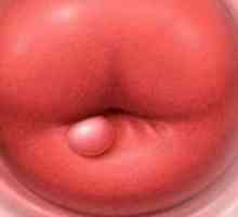 Ce este polipi de col uterin?