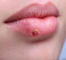 Herpes pe fața gravidă: cum de a trata?