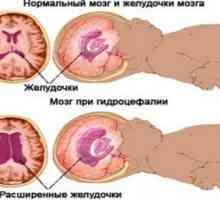 Hidrocefalia creierului la sugari