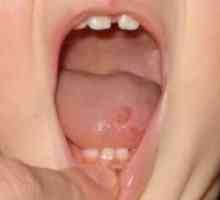 Răni pe limba copilului