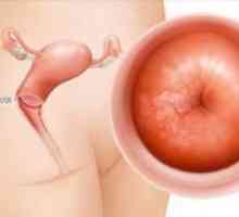 Ectropion de col uterin