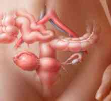 Chist ovarian endometrioide si sarcina