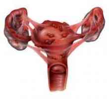 Chisturi endometrioid: cauze, simptome, tratament