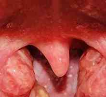 Cât de repede și eficient să identifice și să trateze boala limbii albastre din copilărie anginei
