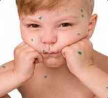 Cum de a trata varicela la copii?