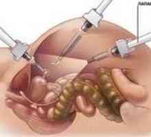 Cum este chist ovarian laparoscopic?