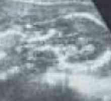 Pe masura ce colul uterin în timpul sarcinii indică riscul de nastere prematura
