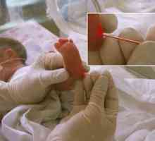 Care este rata de bilirubina in sange de nou-născut