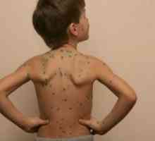 Care sunt complicatiile sau consecintele dupa varicela la copii