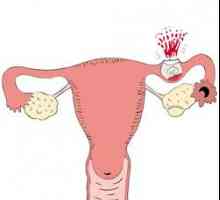 Care sunt semnele unei sarcini extrauterine, o femeie are nevoie să știe?