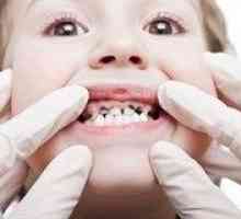 Cariilor dentare la copii - Tratament si Prevenire