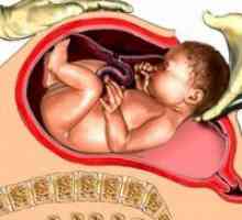 Cesarean nașterii sau vaginală, contra naștere