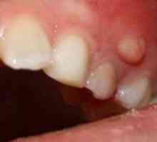 Periuțe de dinți: cauze, simptome, tratament