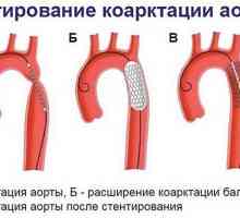 Coarcta a aortei la copii - cauze, tipuri, tratament