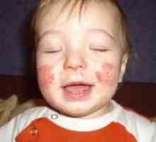 Boli de piele la copii