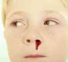 Sângerări nazale la copii
