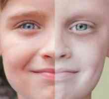 Leucemia la copii: simptome si tratament