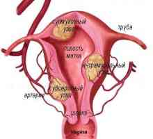 Fibroame, fibroamele si fibrom uterin