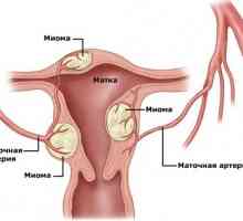 Fibrom uterin in timpul sarcinii