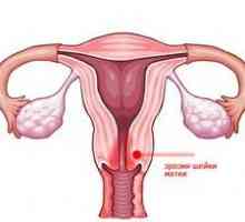 Are eroziune de col uterin este periculos?