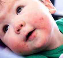 Pericol virusul Coxsackie pentru copii