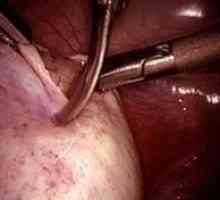 Chirurgia pentru chist ovarian - lecturi, formare și reabilitare