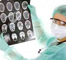 Brain tumorala - simptome si tratament