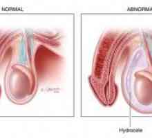 Tumora scrotal intr-un nou-născut - o testiculele hidrocel!