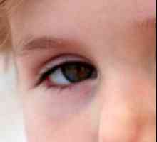 Umflarea, pungile de sub ochii unui copil