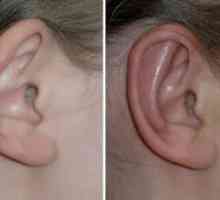 Urechi din plastic. Corectarea urechilor