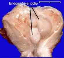 Polip de col uterin și endometrial