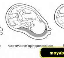 Placenta previa