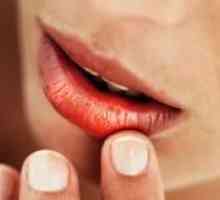 Cauzele și tratamentul fisuri la colturile gurii