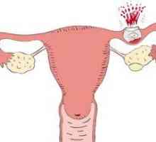 Cauze și simptome ale unei sarcini extrauterine