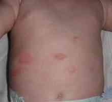 Cauzele rash pe abdomen copilului