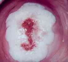 Simptomele și tratamentul verucilor genitale