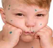 Simptomele de varicela la copii
