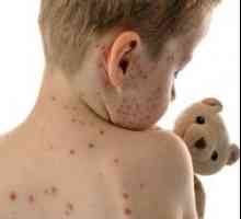 Prevenirea varicela la copii