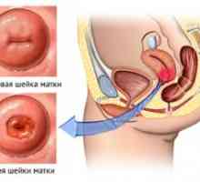 Ruptură de col uterin in timpul nasterii - modul de a preveni această complicație?