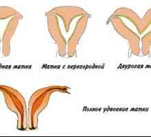 Uterului Saddle in timpul sarcinii: cauze si tratament