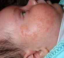 Simptomele și tratamentul dermatitei atopice la copii