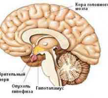 Simptomele si tratamentul tumorilor cerebrale la copii